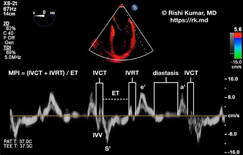 Myocardial performance index, a Doppler